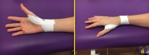 vendaje_funcional